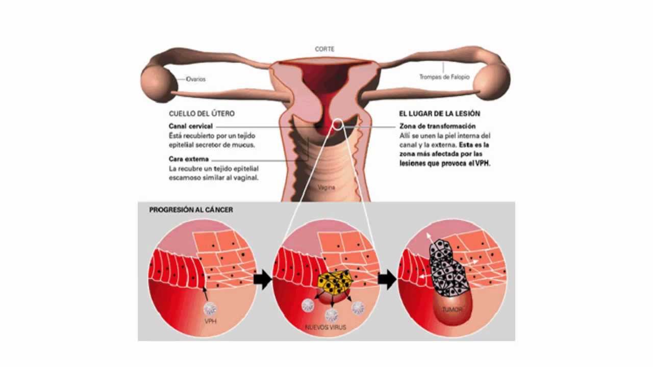 Las mujeres contagian más el HPV Las mujeres contagian más el HPV